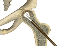 Core Decompression for Avascular Necrosis of the Hip 