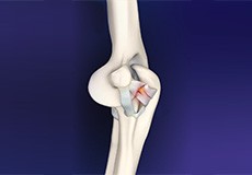 Elbow Ligament Injury
