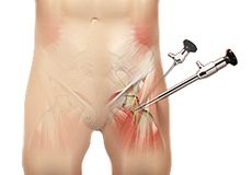 Hip Arthroscopy