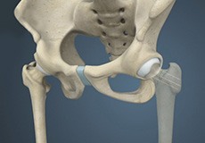 Hip Fracture