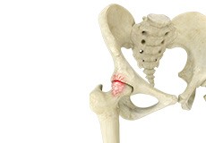 Hip Impingement