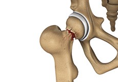 Hip Injury