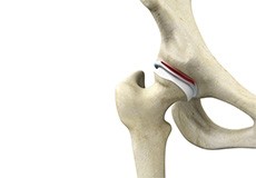 Hip Impingement