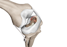 Meniscal Injuries