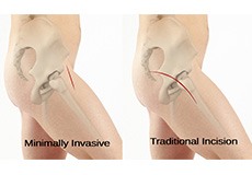 Minimally Invasive Total Hip Replacement