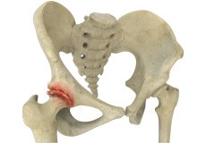 Hip Arthritis