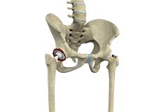 Revision Hip Replacement