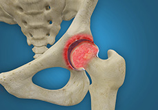 Rheumatoid arthritis