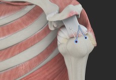 Rotator Cuff Repair