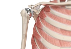 Total Shoulder Replacement