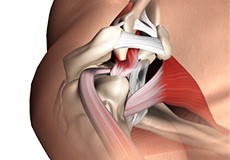 Subacromial Decompression