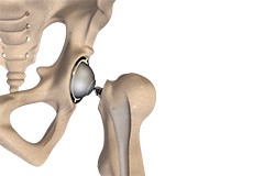 Total Hip Replacement