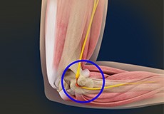 Ulnar Nerve Entrapment 